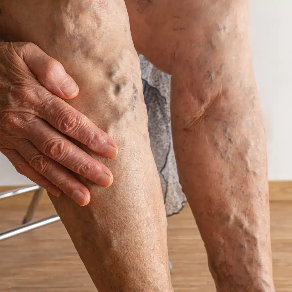 varicose veins