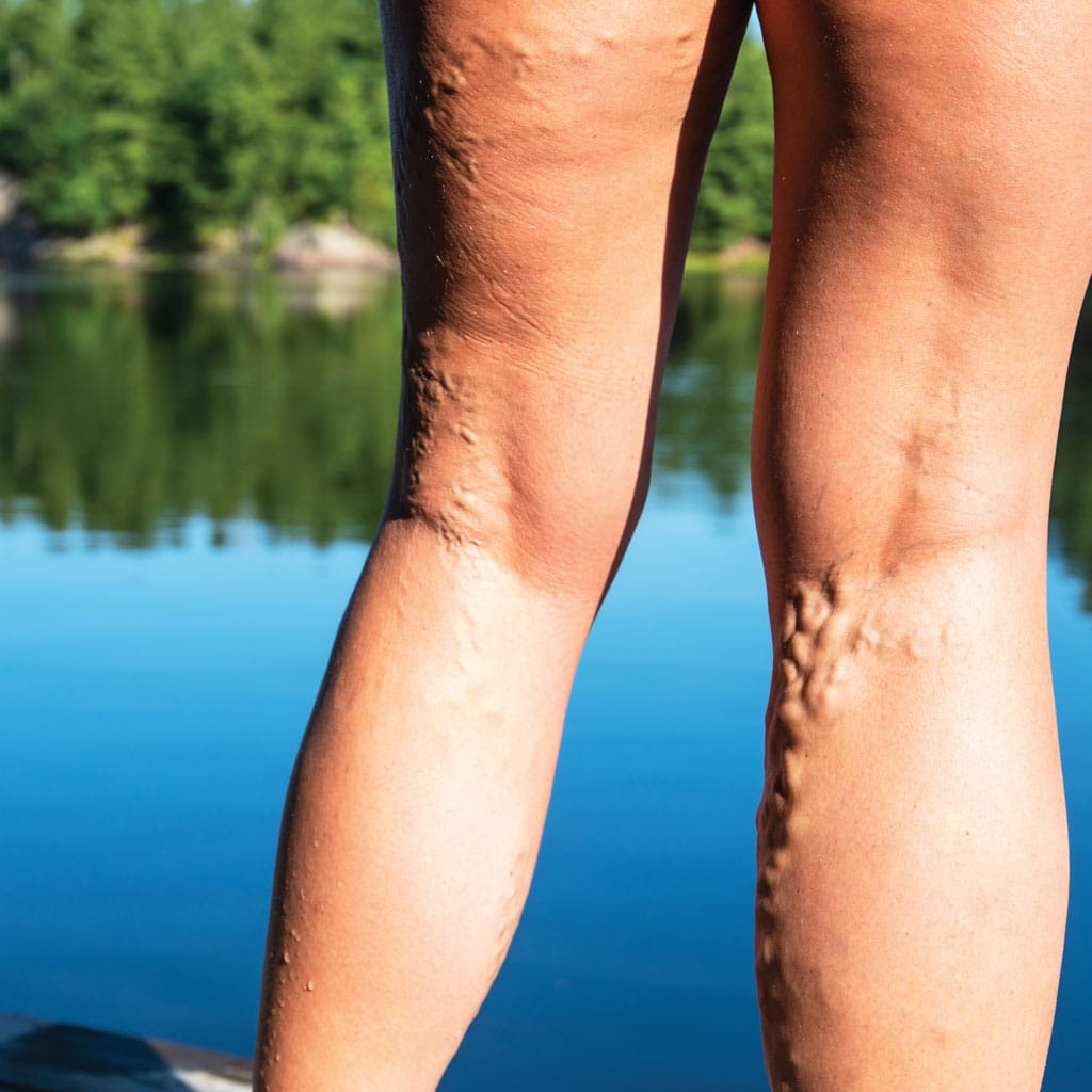 Varicose Veins