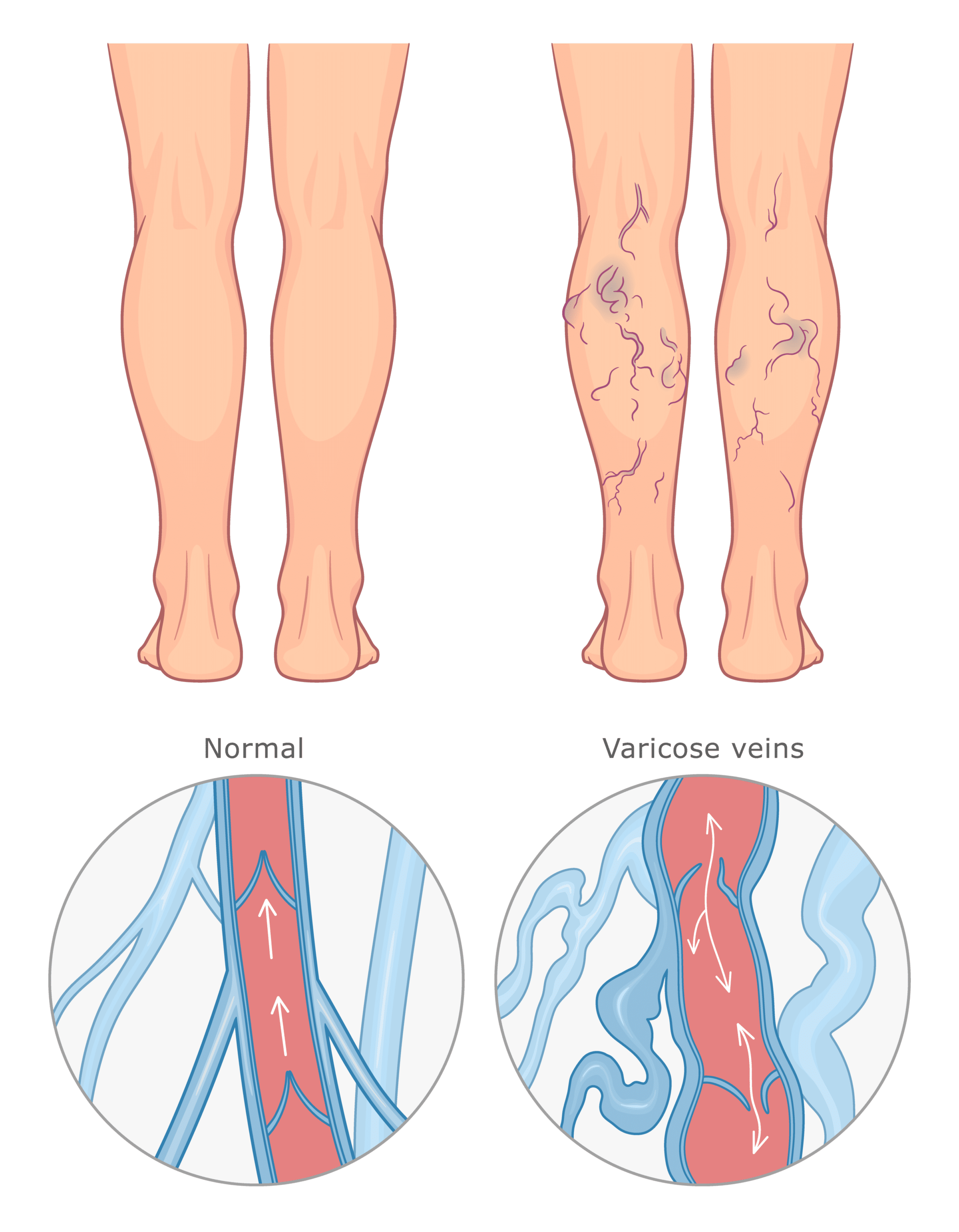 varicose veins versus healthy veins