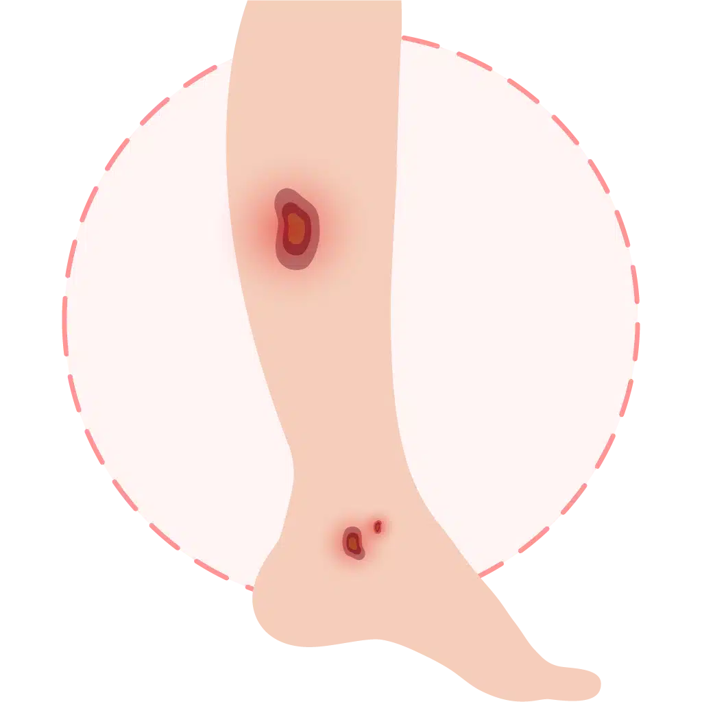 leg ulcers