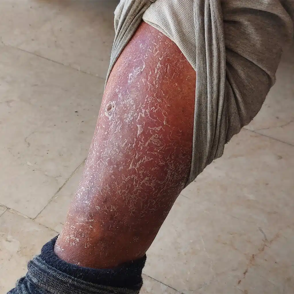 Venous Leg Ulcers treatment