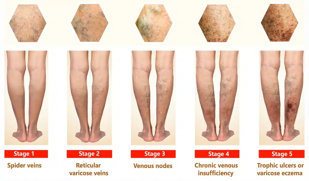 stages of Chronic Venous Insufficiency