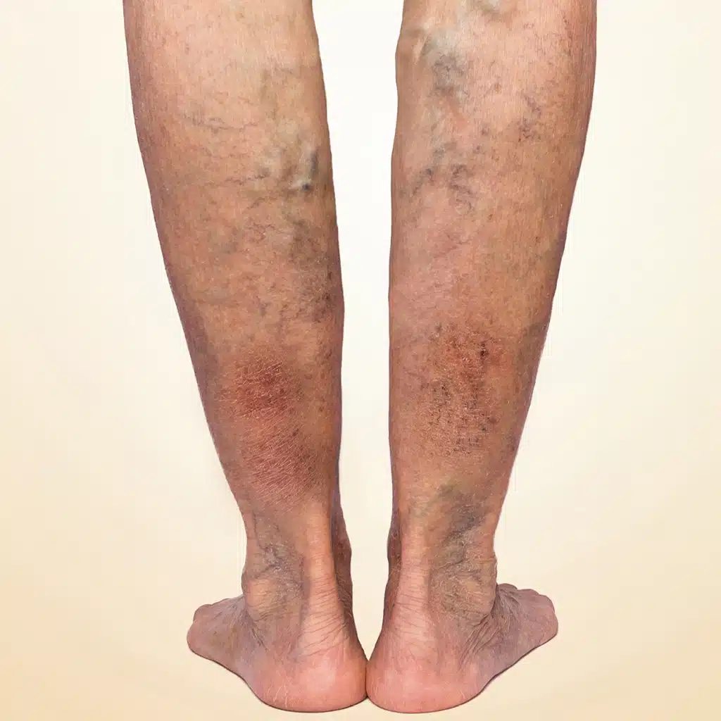 Superficial Thrombophlebitis