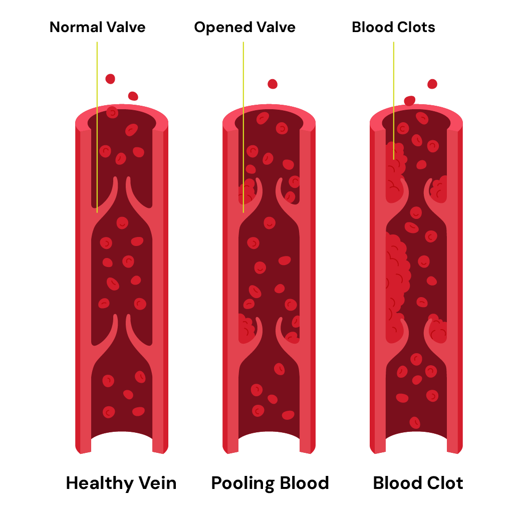 blood clots forming
